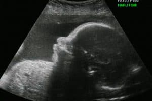 Ecocardiograma Fetal: Qual a importância deste exame e por que realizá-lo no pré-natal?