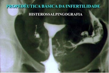 Histeroscopia e Infertilidade