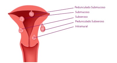 tipos de mioma uterino